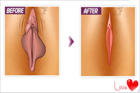 The before and after labia minora reduction procedure