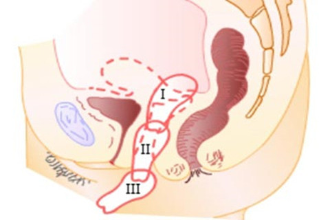 The picture shows three degrees of uterine ptosis