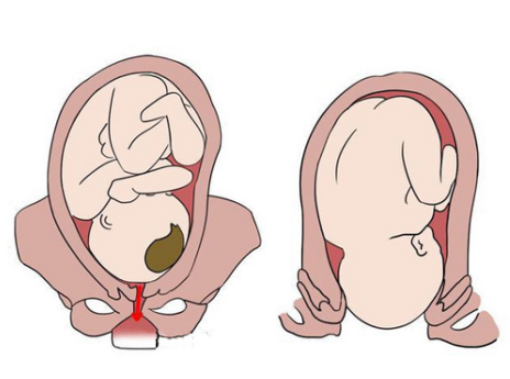 The picture shows a baby born by vaginal cavity