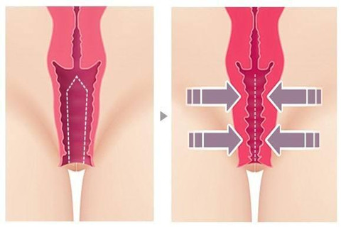 The picture shows the before and after vagianoplasty