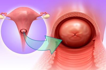 The picture is the simulated diagram of uterine prolapse